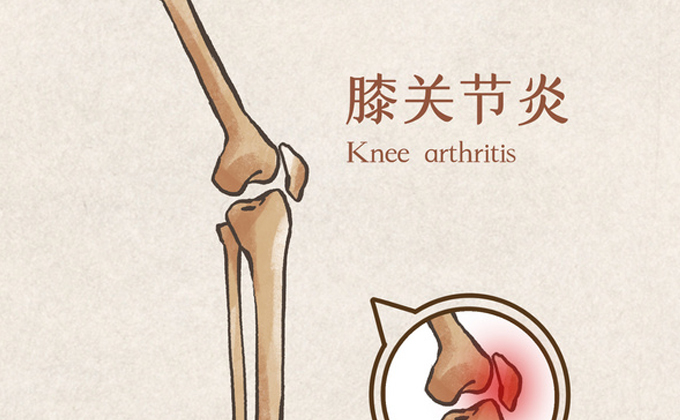 关于膝关节的保护，有人说，运动对膝关节是一种锻炼，也有人说，运动会造成膝关节损伤。什么程度的运动是适宜的？