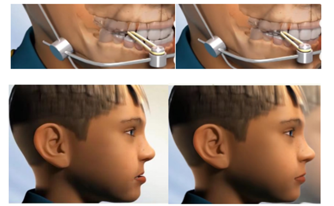 小孩在换牙期间是否能矫正牙齿？成年人的牙齿已经定型，可以矫正吗？